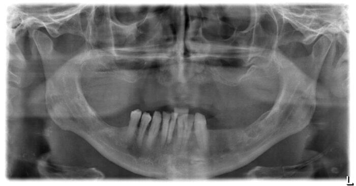 An x-ray film of the patient's upper jaw.