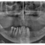An x-ray of the patient's upper jaw