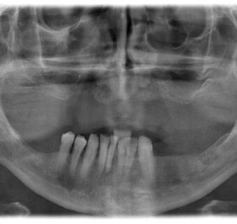 An x-ray of the patient's upper jaw