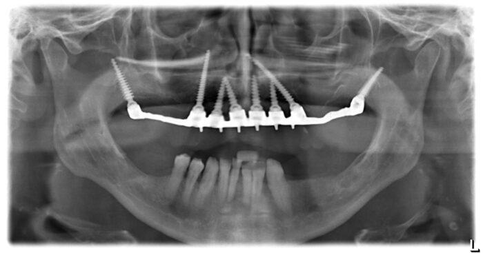 An x-ray image of the patient's jaw with the implant work in place.