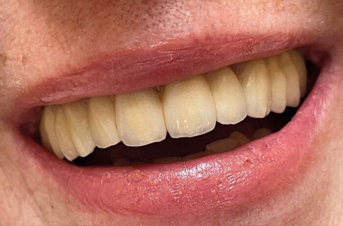 A close up of a smiling happy patient.