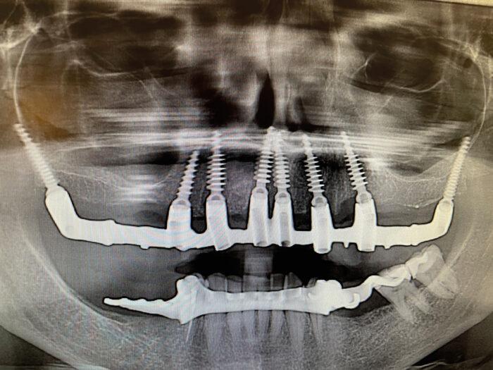 An x-ray from a three month check up.