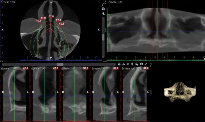 A montage of multiple scans of the upper jaw.