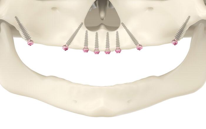 A computer drawing of screw placement in the patient's jaw.