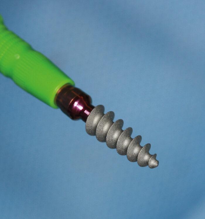 A close up looking at the implant fixture body.