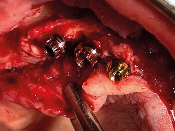 Three multi unit heads after install on the patient's upper jaw.