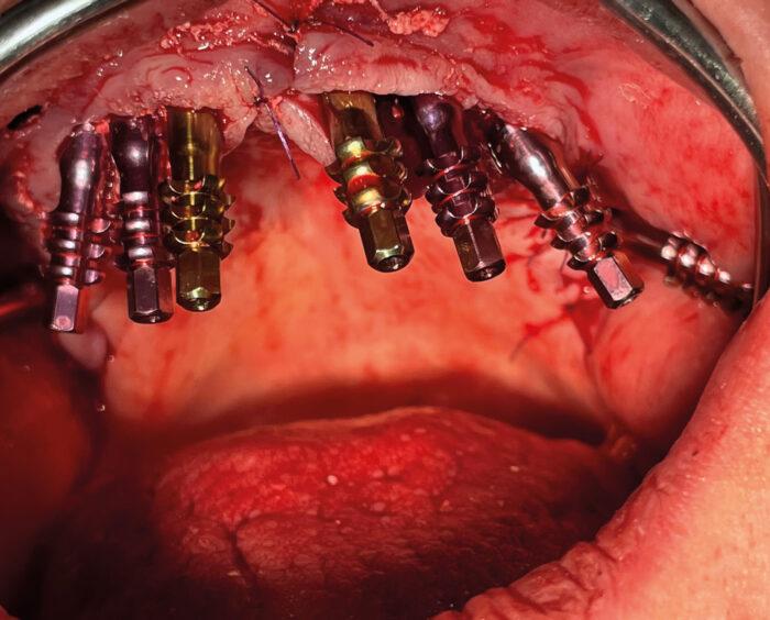 Placing the implants in the upper jaw.