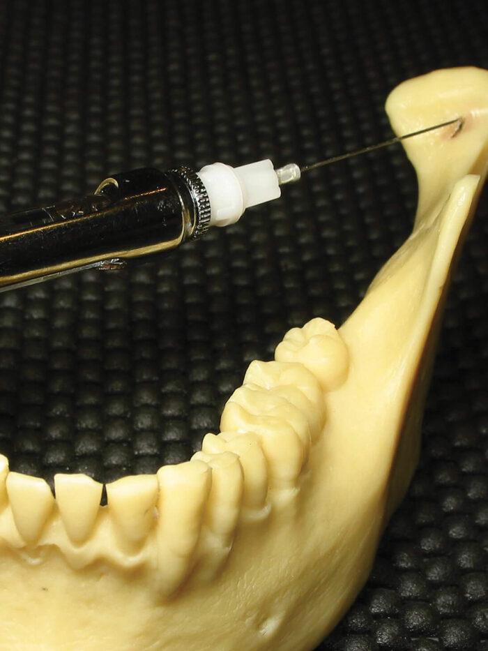 A syringe injecting in to a point at the back of a model jaw.