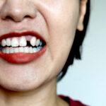 A woman shows off a gap in her upper front teeth.