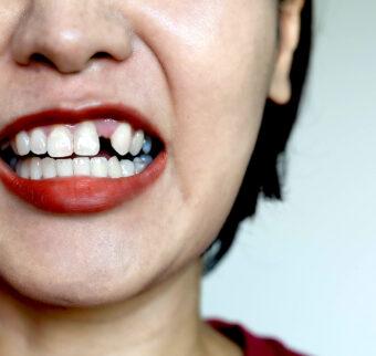 A woman shows off a gap in her upper front teeth.