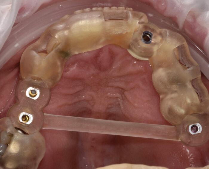 Figure 2: The printed guide with sleeves in position in the patient's mouth