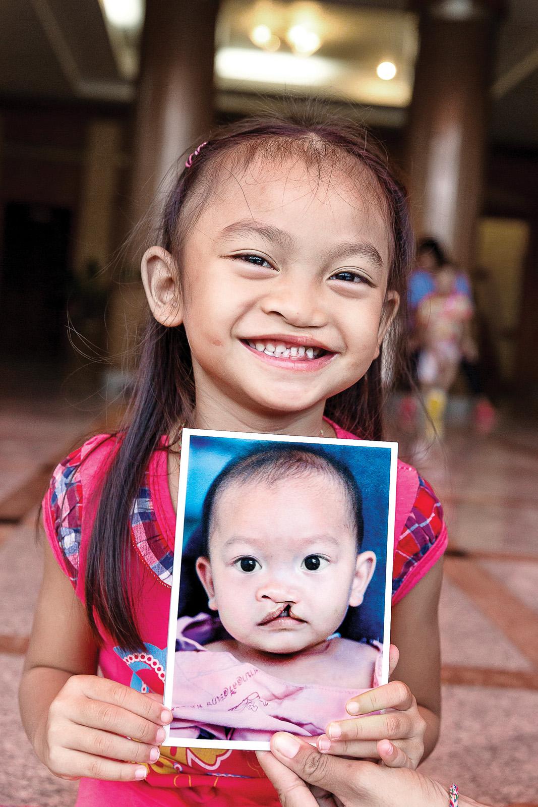 A child holds up a baby picture showing their cleft lip before surgery.