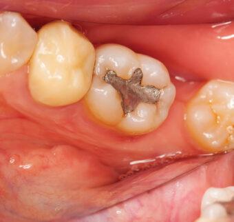 A photograph with the posterior lower molar teeth, one premolar with crown, cavities, gingival affection, fillings, plaque and tartar - taken with a special photography technique, with dental mirror.